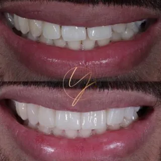 ✨ 𝐒𝐦𝐢𝐥𝐞 𝐮𝐩𝐠𝐫𝐚𝐝𝐞𝐝✨

This lovely patient hated the unevenness of his smile. He felt the teeth slanted to one side, creating a wonky appearance. This was all because he had a missing front tooth (canine) on one side!

We improved the colour with 𝐓𝐞𝐞𝐭𝐡 𝐖𝐡𝐢𝐭𝐞𝐧𝐢𝐧𝐠 and created an even beautiful smile with 𝟔 𝐂𝐨𝐦𝐩𝐨𝐬𝐢𝐭𝐞 𝐕𝐞𝐧𝐞𝐞𝐫𝐬

🔹Teeth Whitening - Home kit 2 weeks
🔹Composite Bonding - same day, one appointment
🔹No drilling/ No pain/ Netflix on while you relax !

📍 Harborne & Solihull
📱 DM Enquiries

#birminghamdentist #solihulldentist #compositebonding #compositeveneers #smilemakeover #birminghamcompositebonding #cosmeticdentist #cosmeticdentistbirmingham #teethwhiteningbirmingham