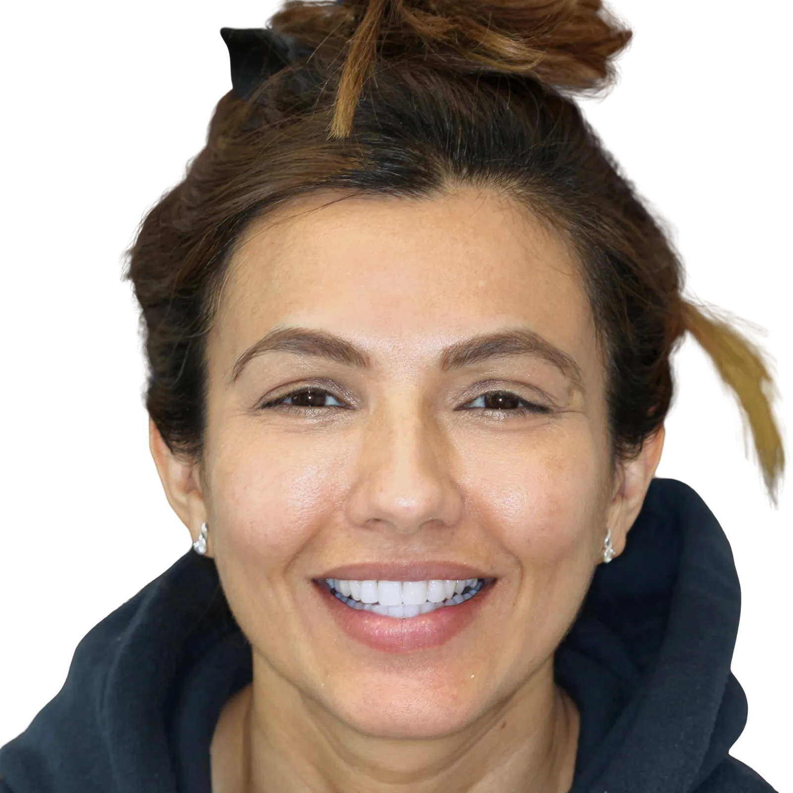 tooth whitening birmingham