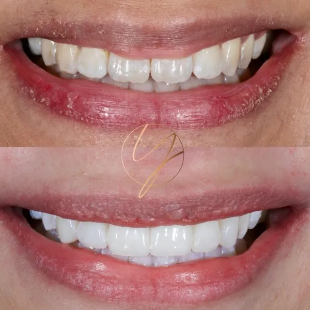✨ 𝐒𝐢𝐱 𝐂𝐨𝐦𝐩𝐨𝐬𝐢𝐭𝐞 𝐕𝐞𝐧𝐞𝐞𝐫𝐬 - 𝐓𝐨𝐩 𝐭𝐞𝐞𝐭𝐡✨

Placed to improve edges, shapes and colour of teeth improving the overall symmetry of the smile 🥰

📍 Available Birmingham & Solihull
📱 DM Enquiries
🔹 0% Finance available

#compositebonding #compositeveneers #smilemakeover #compositebondingbirmingham #dentistbirmingham #cosmeticdentistuk