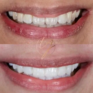 ✨ 𝐒𝐢𝐱 𝐂𝐨𝐦𝐩𝐨𝐬𝐢𝐭𝐞 𝐕𝐞𝐧𝐞𝐞𝐫𝐬 - 𝐓𝐨𝐩 𝐭𝐞𝐞𝐭𝐡✨

Placed to improve edges, shapes and colour of teeth improving the overall symmetry of the smile 🥰

📍 Available Birmingham & Solihull
📱 DM Enquiries
🔹 0% Finance available

#compositebonding #compositeveneers #smilemakeover #compositebondingbirmingham #dentistbirmingham #cosmeticdentistuk