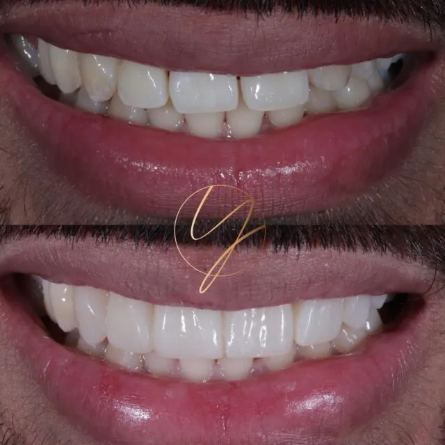 ✨ 𝐒𝐦𝐢𝐥𝐞 𝐮𝐩𝐠𝐫𝐚𝐝𝐞𝐝✨

This lovely patient hated the unevenness of his smile. He felt the teeth slanted to one side, creating a wonky appearance. This was all because he had a missing front tooth (canine) on one side!

We improved the colour with 𝐓𝐞𝐞𝐭𝐡 𝐖𝐡𝐢𝐭𝐞𝐧𝐢𝐧𝐠 and created an even beautiful smile with 𝟔 𝐂𝐨𝐦𝐩𝐨𝐬𝐢𝐭𝐞 𝐕𝐞𝐧𝐞𝐞𝐫𝐬

🔹Teeth Whitening - Home kit 2 weeks
🔹Composite Bonding - same day, one appointment
🔹No drilling/ No pain/ Netflix on while you relax !

📍 Harborne & Solihull
📱 DM Enquiries

#birminghamdentist #solihulldentist #compositebonding #compositeveneers #smilemakeover #birminghamcompositebonding #cosmeticdentist #cosmeticdentistbirmingham #teethwhiteningbirmingham