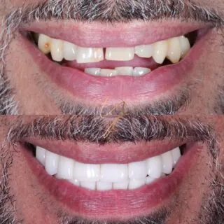 🔥 𝕻𝖔𝖗𝖈𝖊𝖑𝖆𝖎𝖓 𝖒𝖆𝖌𝖎𝖈 🔥

Orthodontic treatment is not for everyone. While it is the gold standard in teeth that are misaligned - This gentleman in particular did not want braces. So we discussed all the other options and talked in depth about the pros and cons of each.

In the end, we decided that porcelain veneers would be the best option for him.

When formulating a treatment plan, not only do we take into consideration the best options but also the best fit for the patients lifestyle.

🔹 Upper and lower 20 porcelain veneers
⏰ Treatment time - 4 weeks
📍 Solihull @ascentsolihull 
.
.
.
#dentist #dentista #cosmeticdentistry #cosmeticdentist #solihull #solihulldentist #birmingham #birminghamdentist #porcelainveneers #porcelainteeth