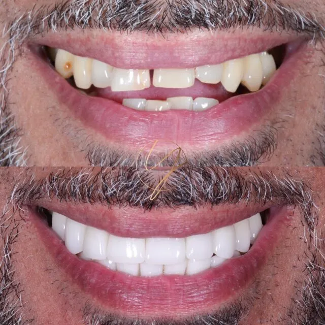 🔥 𝕻𝖔𝖗𝖈𝖊𝖑𝖆𝖎𝖓 𝖒𝖆𝖌𝖎𝖈 🔥

Orthodontic treatment is not for everyone. While it is the gold standard in teeth that are misaligned - This gentleman in particular did not want braces. So we discussed all the other options and talked in depth about the pros and cons of each.

In the end, we decided that porcelain veneers would be the best option for him.

When formulating a treatment plan, not only do we take into consideration the best options but also the best fit for the patients lifestyle.

🔹 Upper and lower 20 porcelain veneers
⏰ Treatment time - 4 weeks
📍 Solihull @ascentsolihull 
.
.
.
#dentist #dentista #cosmeticdentistry #cosmeticdentist #solihull #solihulldentist #birmingham #birminghamdentist #porcelainveneers #porcelainteeth